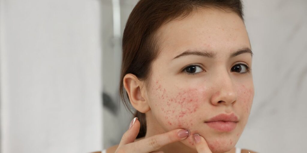 Cómo tratar las cicatrices del acné y prevenir nuevos brotes - bellezaenverde.com - Belleza en verde