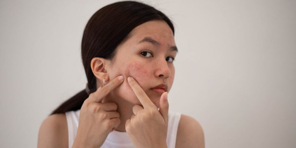 ¿Cuáles son los mejores productos para el cuidado de la piel para la piel propensa a acné? - bellezaenverde.com - Belleza en verde
